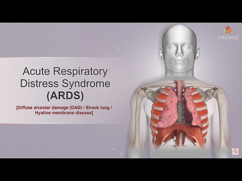 Acute respiratory distress syndrome ( ARDS ) Etiology, Clinical features, Diagnosis, and Treatment