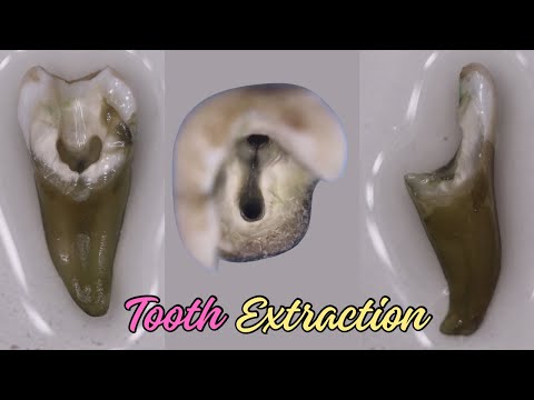 Tooth Extraction