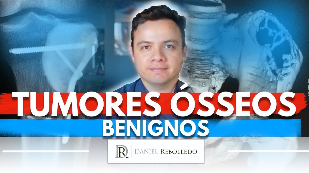 Tumores Ósseos Benignos. Tipos mais comuns na infância, tratamento e cirurgias