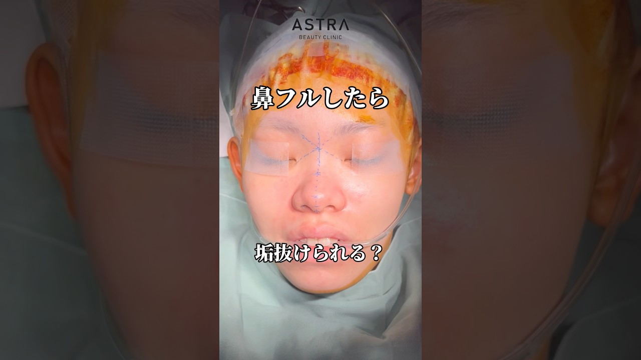 鼻フルで垢抜け💖#astrabeautyclinic  #アストラビューティークリニック #塩満恵子 #鼻整形 #美容整形 #忘れ鼻