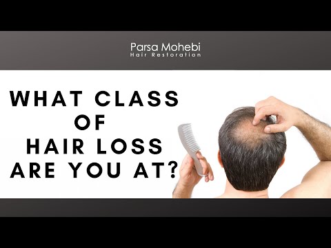 What stage of Hair Loss are you at? (Classes of Hair...