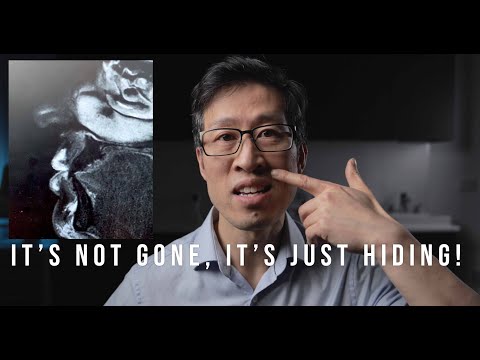 why the lip filler standard is too much...