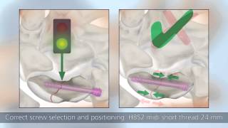 HBS 2 | Minimally invasive palmar surgical technique