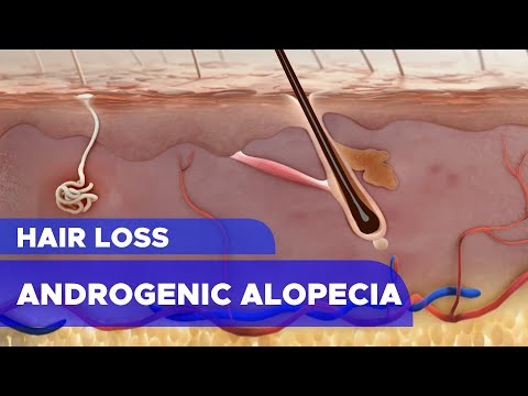 Hair Loss: Androgenic Alopecia