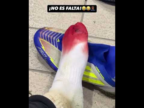 OUCHH 😳😯 Lamine Yamal compartió cómo quedó su pie vs Las Palmas #shorts | ESPN Deportes