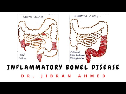 GASTRIC CARCINOMA II GIT II ROBBINS 10TH E II PATHOLOGY LECTURES II DrJIBRANAHMED