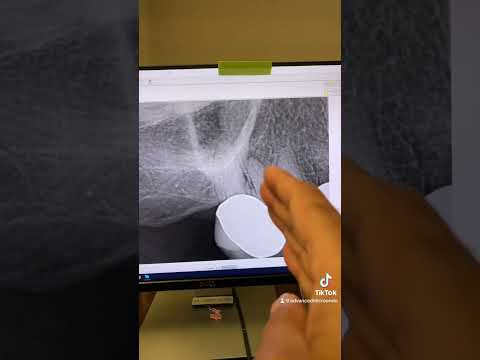 Calcified canals and I had to go through a crown to do the rct!