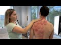 KRAKEN THERAPY Joint CRUNCHES Skin Suctioning