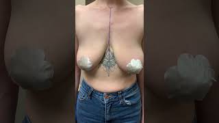 Download lagu Breast Lift- Before and After! mp3