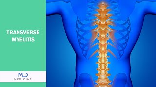 Understanding Transverse Myelitis: Causes, Symptoms, and Treatment Options - @mdmedicine.network