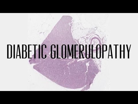 44.  Diabetic glomerulopathy