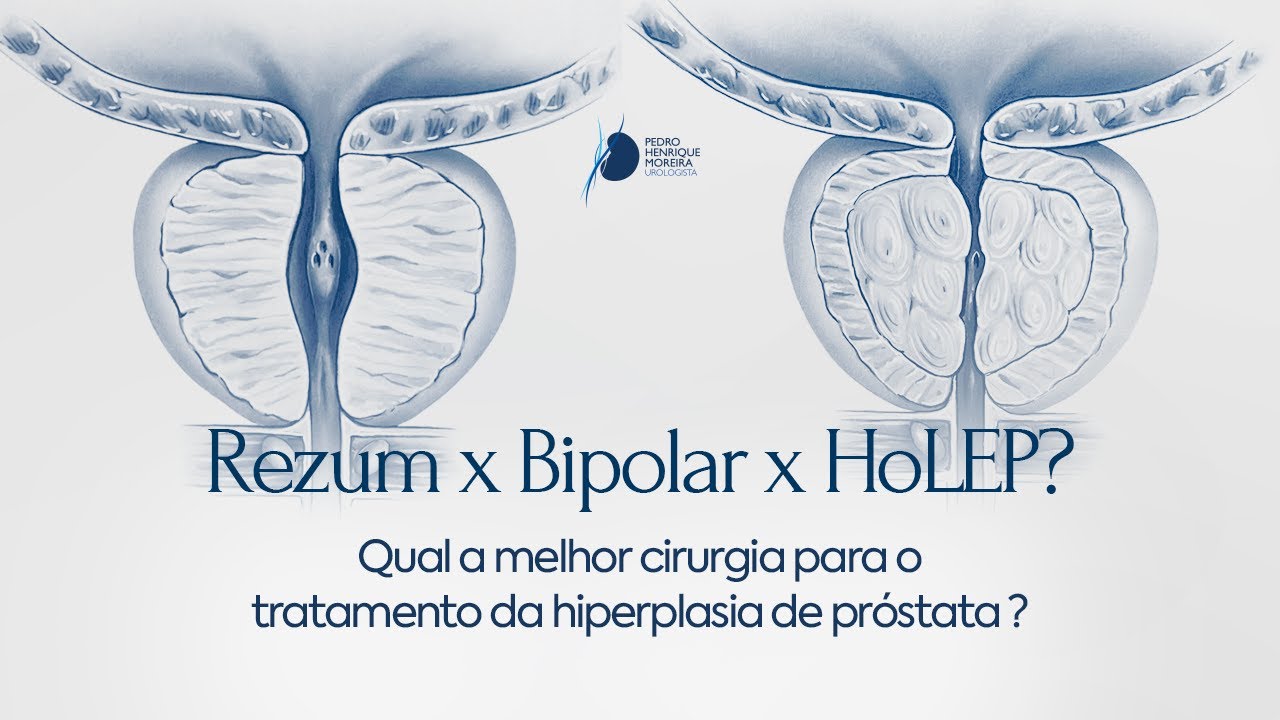 Rezum, Bipolar, HoLEP - qual é a melhor cirurgia para tratar a hiperplasia de próstata?