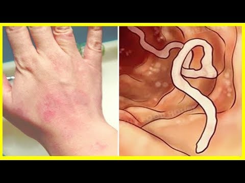 Pode haver eczema em uma perna de foto O mágico em psoríase
