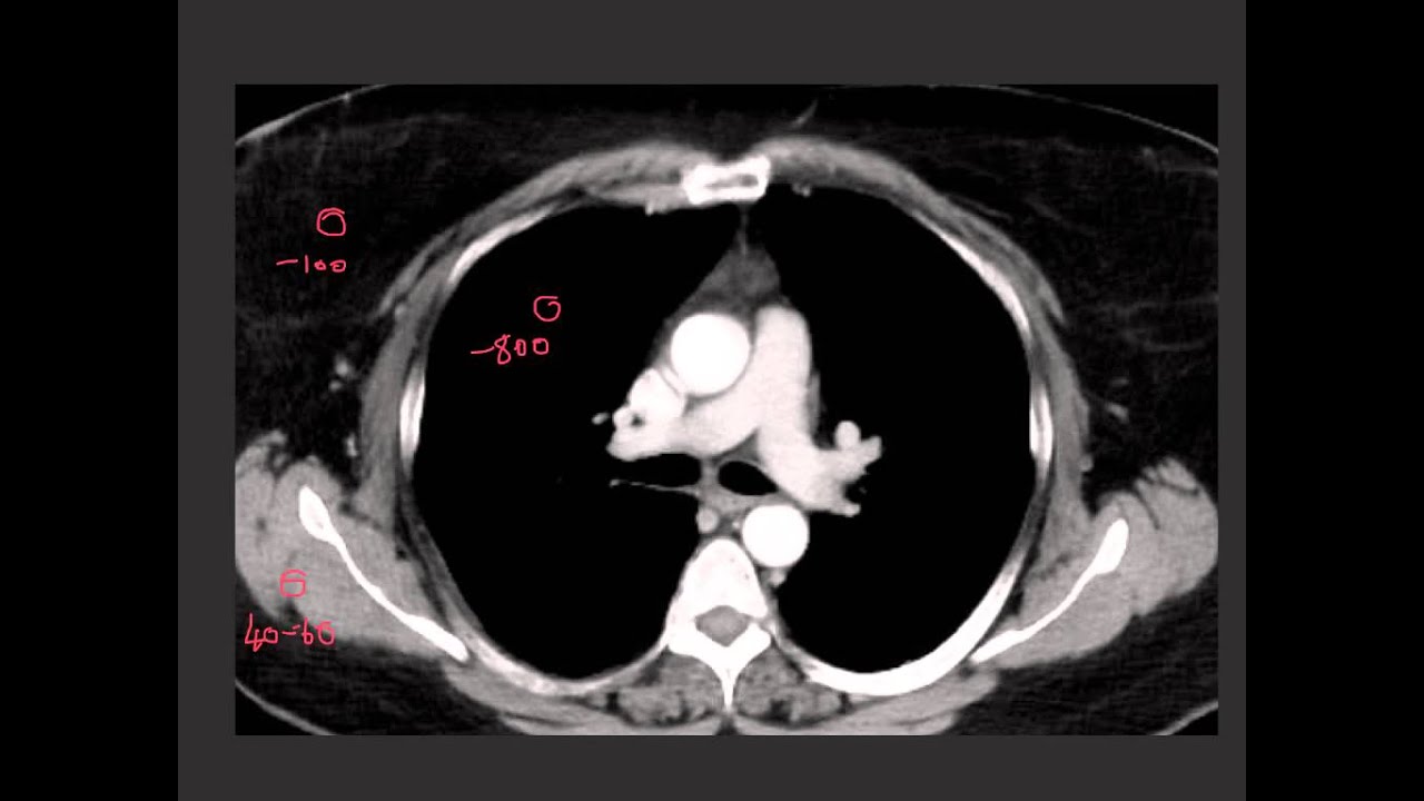 Understanding CT windows, levels and densities