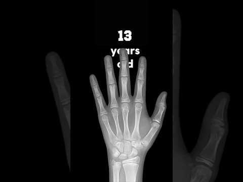 Watch those growth plates FUSE! Hand XR time lapse: 1 day - 18 years #anatomy #xray #pediatrics