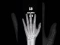 Watch those growth plates FUSE! Hand XR time lapse: 1 day - 18 years #anatomy #xray #pediatrics