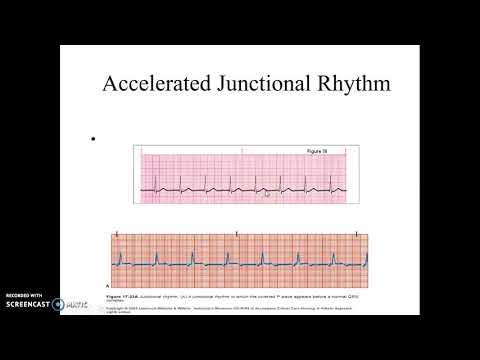 Accelerated Junctional and Junctional Tachycardia