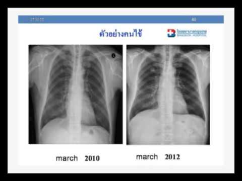 ไม่ชาเขียวในความอ่อนแอ ไส้เลื่อนเอียงและความแข็งแรง