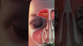 Balloon Sinuplasty Procedure | Opening Blocked Sinus Passage (3D Animation)#balloonsinuplasty