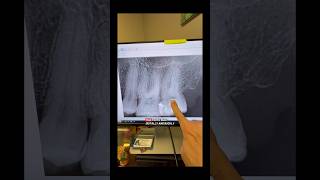 #dentists #apexdental #rootcanaltherapy #dentalartistry #dentalcare