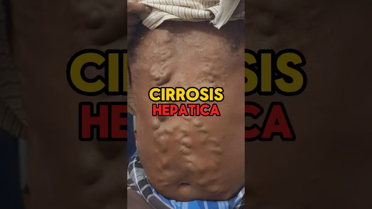 Liver cirrhosis: the face of alcoholism, when your liver says enough | Part 2 #medicine #shorts