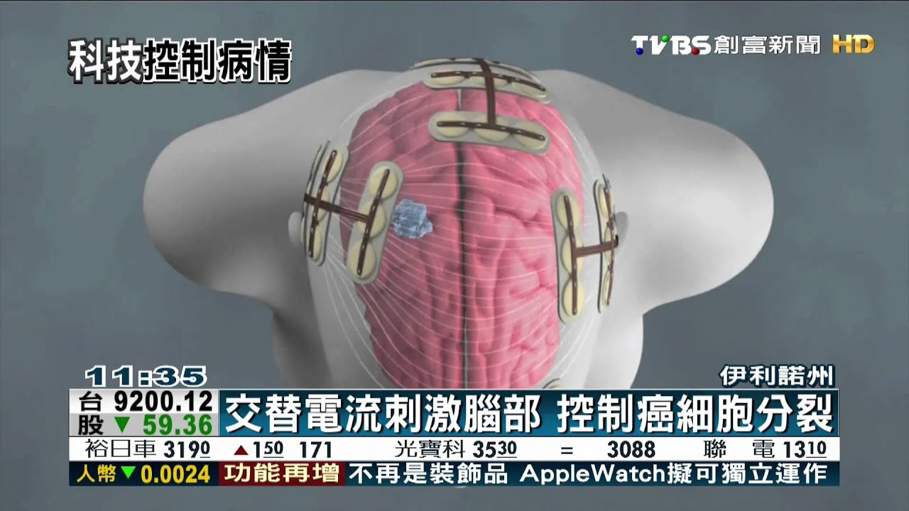 阻止癌細胞分裂 美電療頭罩控制病情