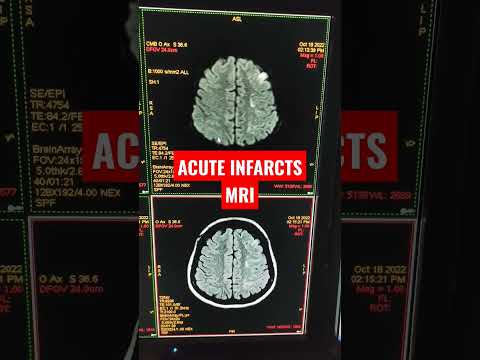 Acute Infarcts on MRI of Brain Stroke Protocol #shorts #viral