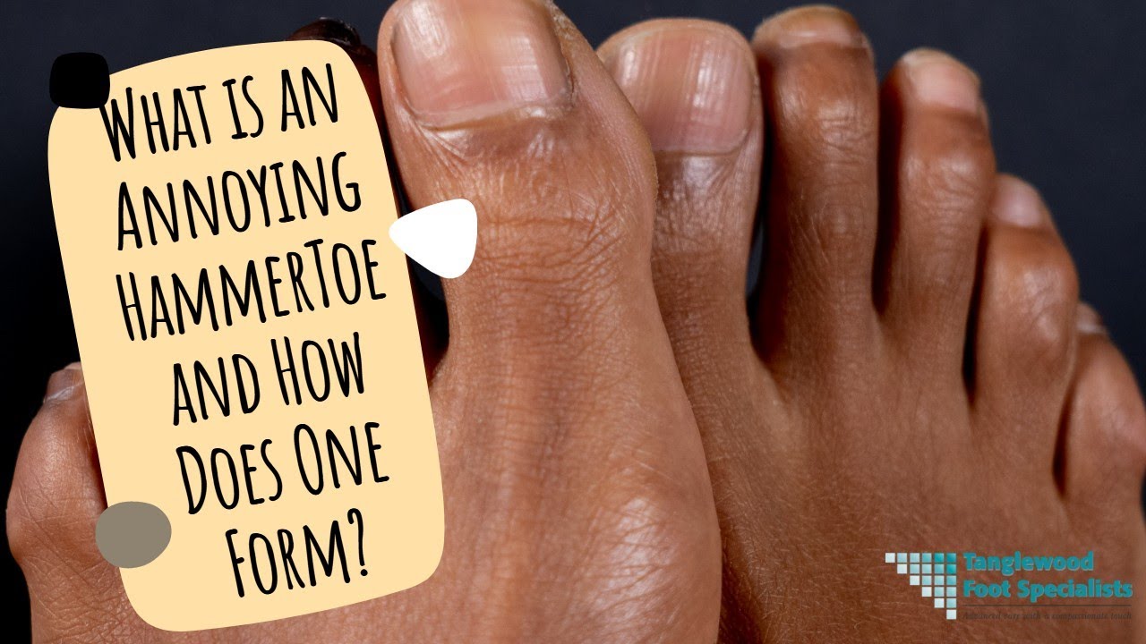 What is an Annoying Hammer Toe and How Does One Form?