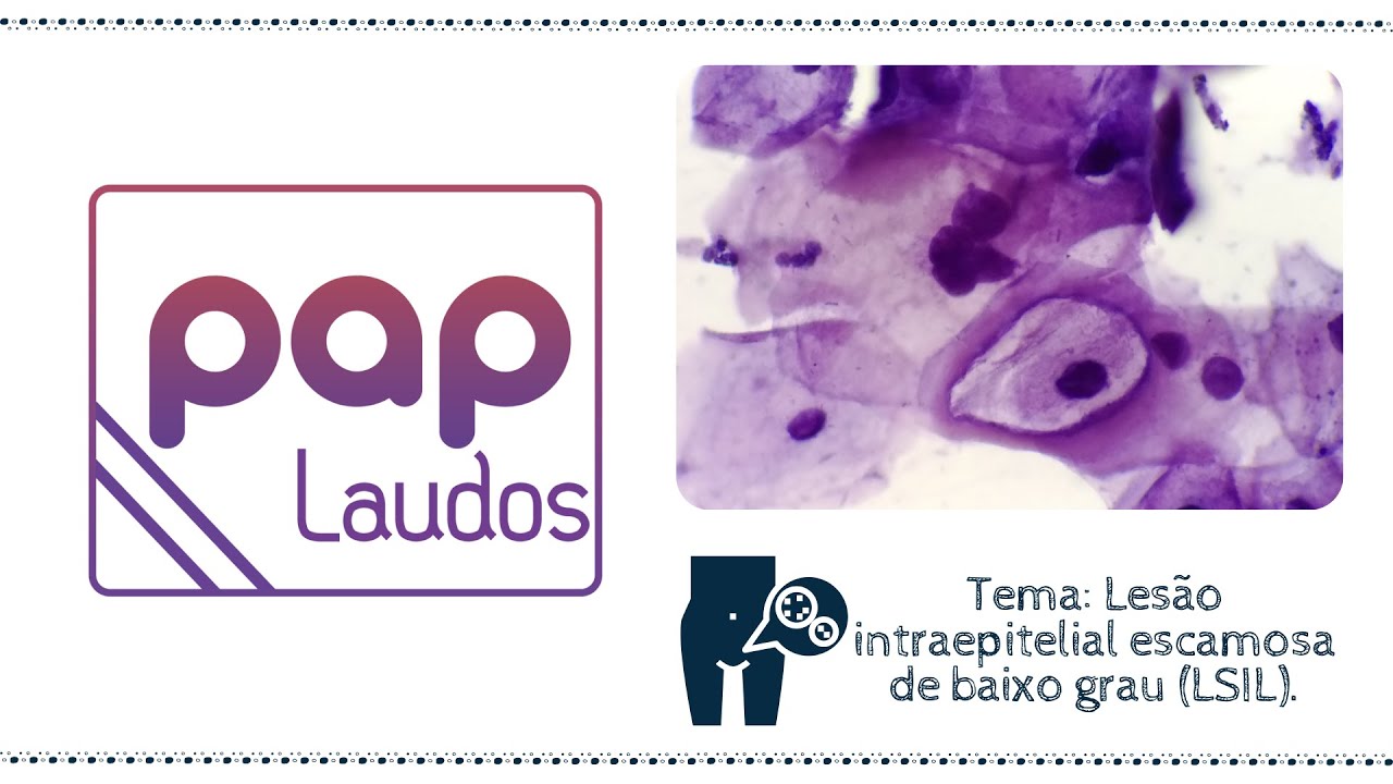 PapLaudos 02 - Lesão intraepitelial escamosa de baixo grau (LSIL)