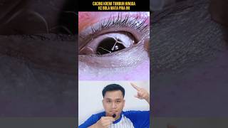 Download lagu CACING KREMI TUMBUH HINGGA KE BOLA MATA PRIA INI‼️#shorts #alurcerita #storytelling mp3