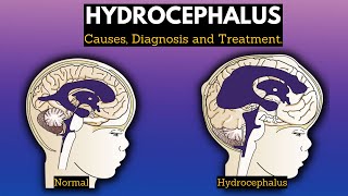 Hydrocephalus, Causes, Signs and Symptoms, Diagnosis and Treatment.
