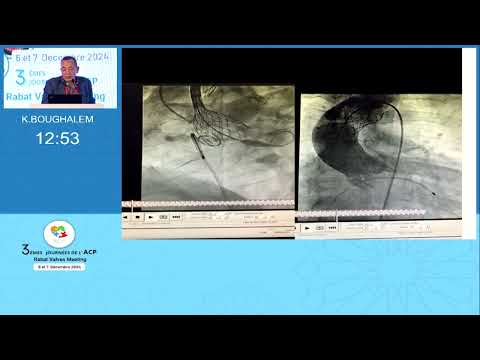 Le TAVI dans l' insufisance aortique NPAR