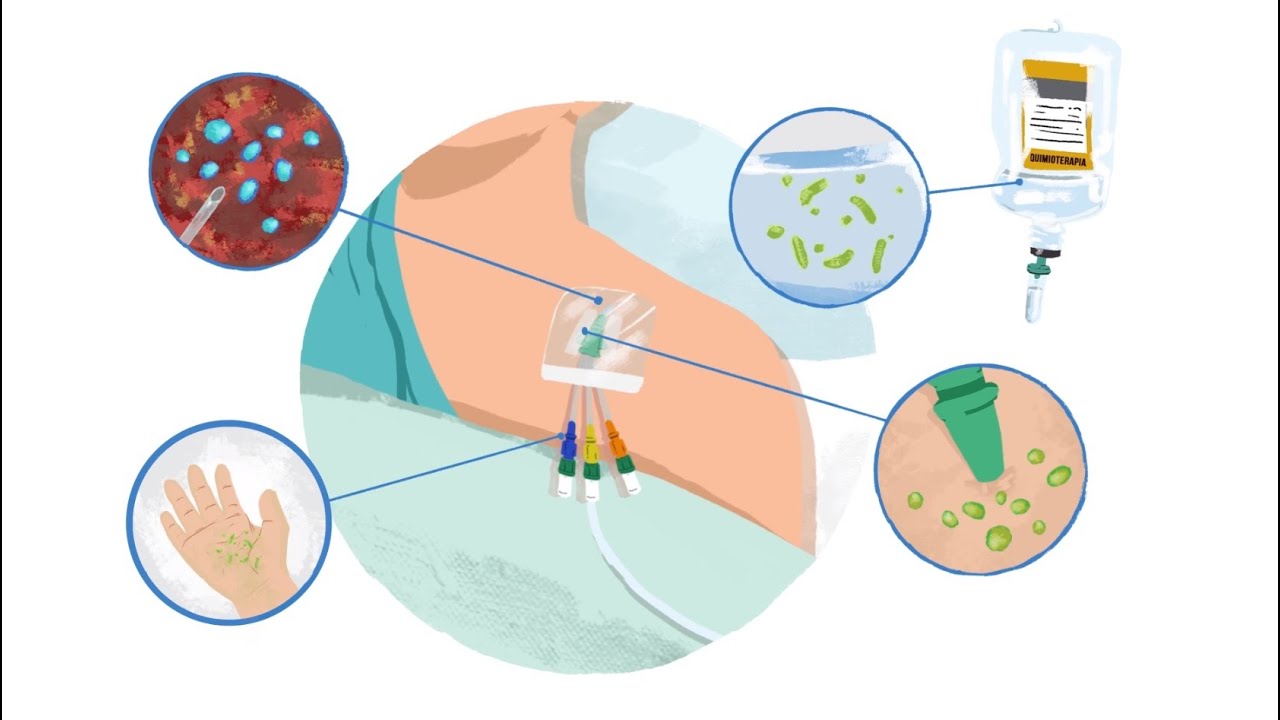 Principais Medidas de Prevenção de Infecção da Corrente Sanguínea
