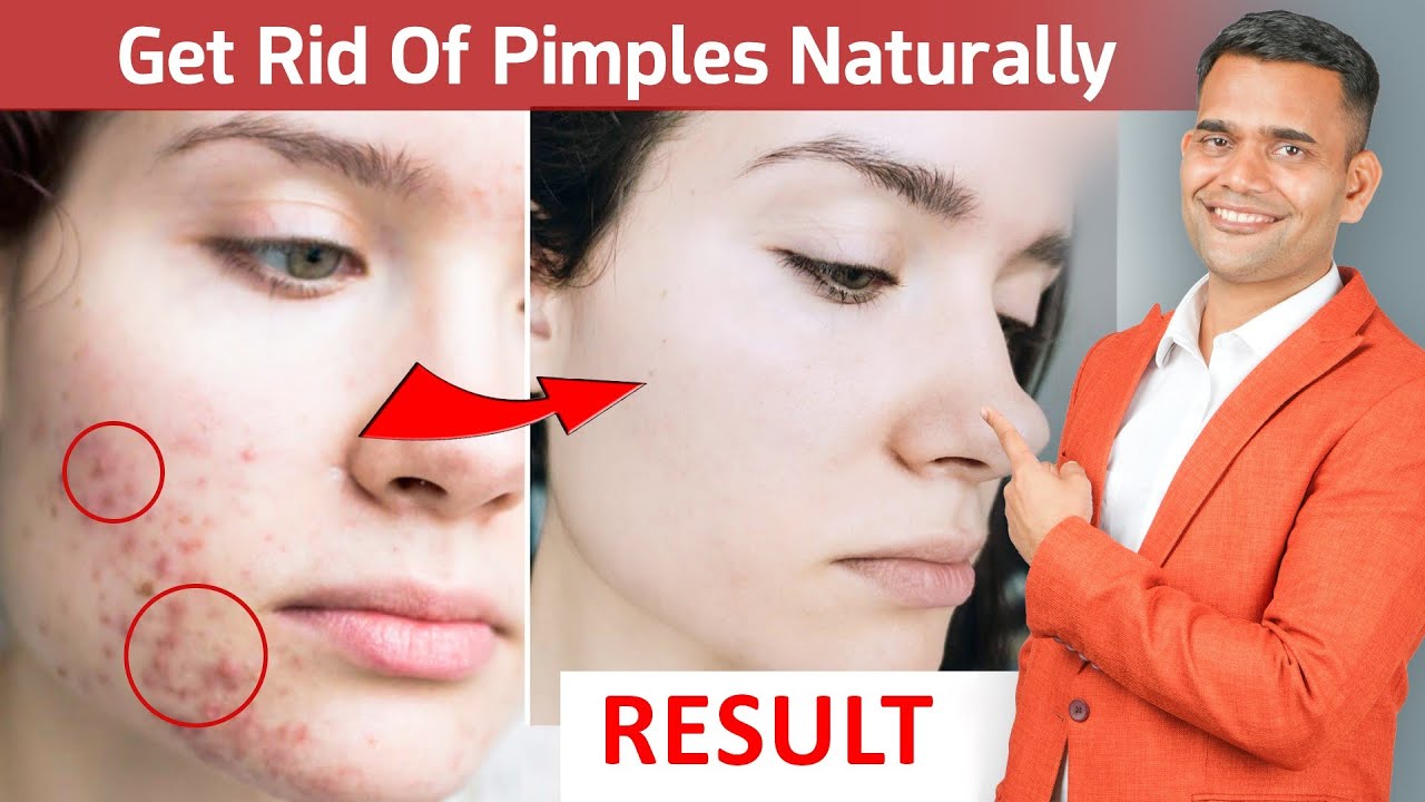 Get Rid Of Pimples Naturally | Natural Ways To Get Rid Of Pimples | Best Ayurvedic Herbs For Pimples