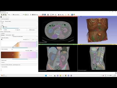 Colorize CT volume rendering with 3D Slicer and TotalSegmentator