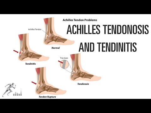 Achilles tendinosis and tendinitis: Signs, symptoms and treatment options