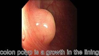 Colon Polyp Simplified