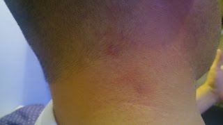 I found a HARD LUMP on the back of my neck - Was It Cancer?