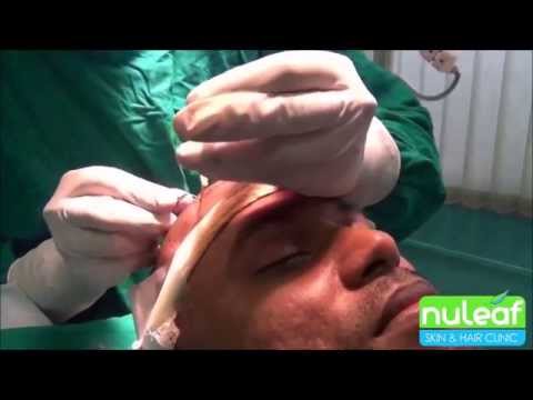 FUE Hair Transplant Surgery in Pune Detailed Video @ Nuleaf Hair Transplant Centre Pune