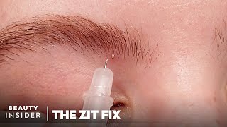 Whitehead-Popping Kit Comes With A Needle To Drain Fluid | The Zit Fix | Beauty Insider