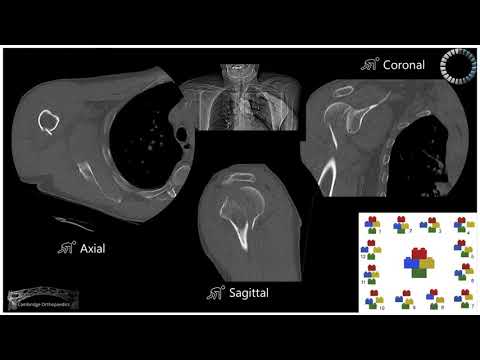 Cases - Shoulder Posterior dislocation