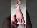 Formlabs Helps Sydney Get A Custom 3D Printed Prosthesis