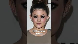 KYLIE JENNER before and after her plastic surgery #trending