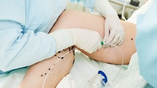 Lazerle Varis Tedavisi (Endovenöz Lazer Ablasyon) Nedir, Nasıl Yapılır