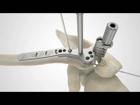 Clavicle Hook Plate Surgical Technique Overview Animation