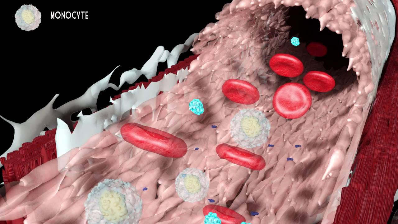 Development of atherosclerosis