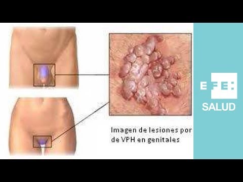 hpv niveau 2