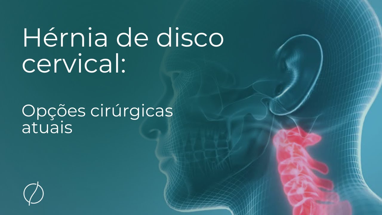 Hérnia de disco cervical: opções cirúrgicas atuais