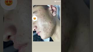 His skin looks great after the acne cleared up