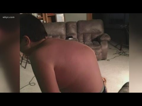 Growth spurt nearly left Stark County teen paralyzed